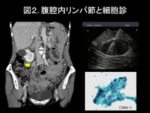 図2.腹腔内リンパ節と細胞診