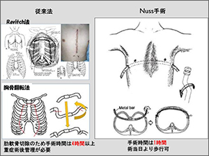 図4．漏斗胸に対する Nuss 手術