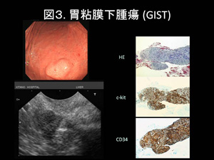 図3.胃粘膜下腫瘍(GIST)
