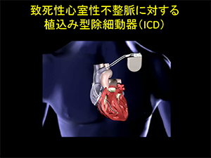 致死性心室性不整脈に対する植込み型除細動器（ICD）