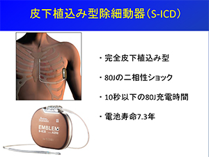 皮下植込み型除細動器（S-ICD）