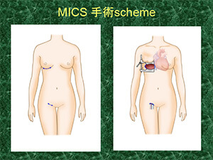 MICS 手術scheme
