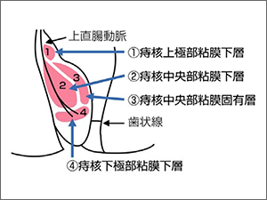 図3．四段階注射法（製品情報概要）